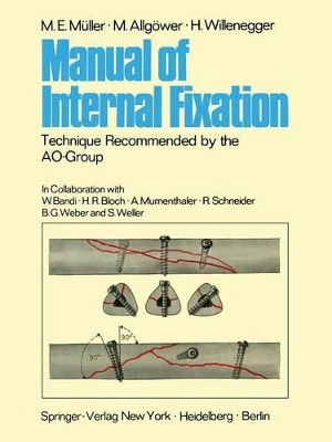 Manual of Internal Fixation: Technique Recommended by the AO-Group Swiss Association for the Study of Internal Fixation: ASIF by M. E. Muller 9783642960673