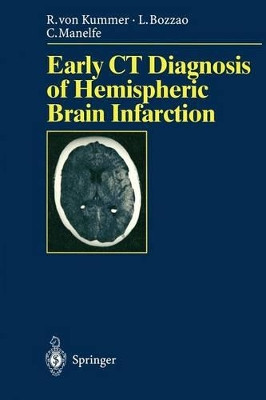 Early CT Diagnosis of Hemispheric Brain Infarction by Rudiger von Kummer 9783540600565