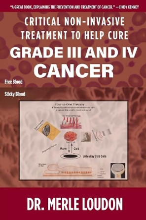 Critical Non-Invasive Treatment to Cure Grade III and IV Cancer by Dr Merle Loudon 9781952685088