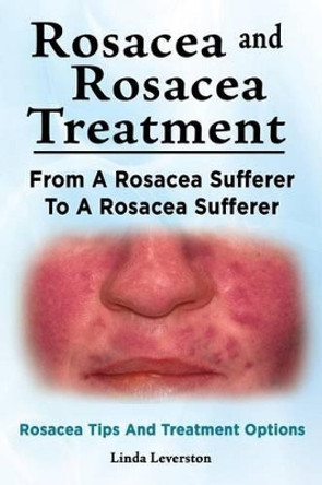 Rosacea and Rosacea Treatment. From A Rosacea Sufferer To A Rosacea Sufferer. Rosacea Tips And Treatment Options by Linda Leverston 9781910941881
