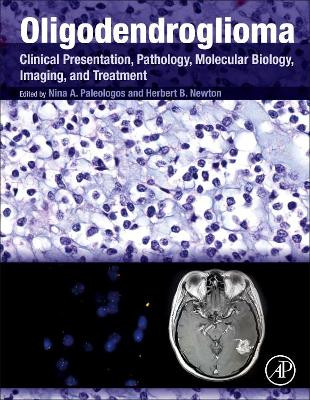 Oligodendroglioma: Clinical Presentation, Pathology, Molecular Biology, Imaging, and Treatment by Nina A. Paleologos 9780128131589