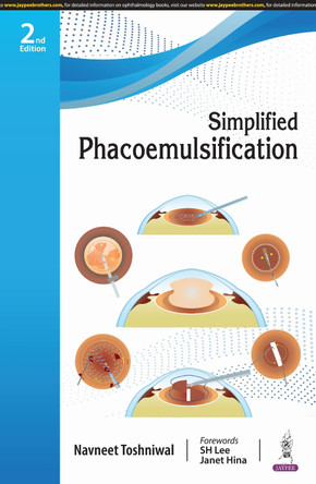 Simplified Phacoemulsification by Navneet Toshniwal 9789356967380