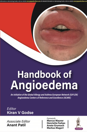 Handbook of Angioedema by Kiran V Godse 9789356961647