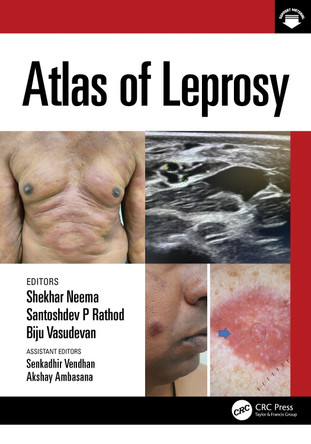 Atlas of Leprosy Shekhar Neema 9781032209234