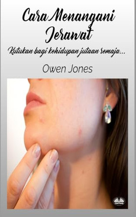 Cara Menangani Jerawat by Owen Jones 9788835461685