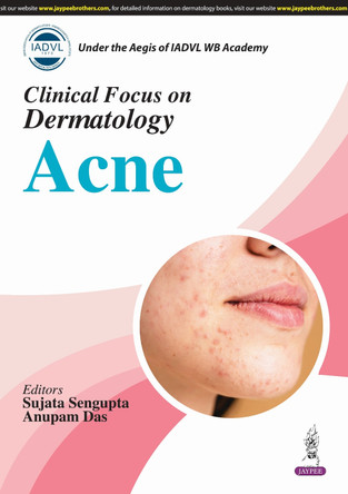 Clinical Focus on Dermatology: Acne by Sujata Sengupta 9789366163048