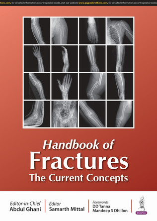 Handbook of Fractures: The Current Concepts by Abdul Ghani 9789366164915