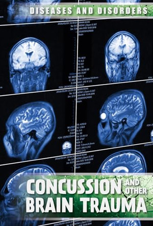 Concussions and Other Brain Trauma by Ryan Nagelhout 9781534561274