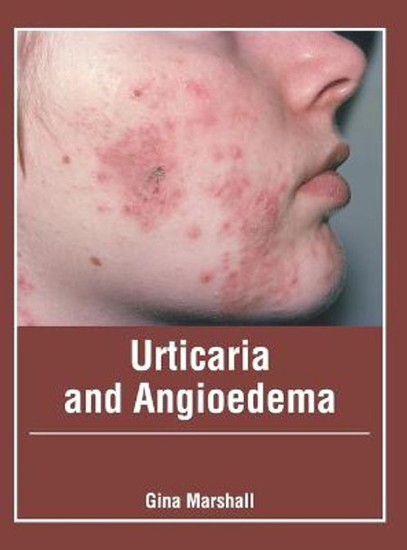 Urticaria and Angioedema by Gina Marshall