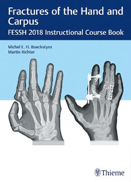 Fractures of the Hand and Carpus: FESSH 2018 Instructional Course Book by Michel E.H. Boeckstyns