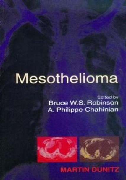 Mesothelioma by Bruce W.S. Robinson