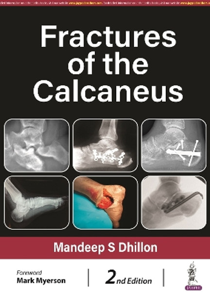 Fractures of the Calcaneus by Mandeep S Dhillon 9789354656651