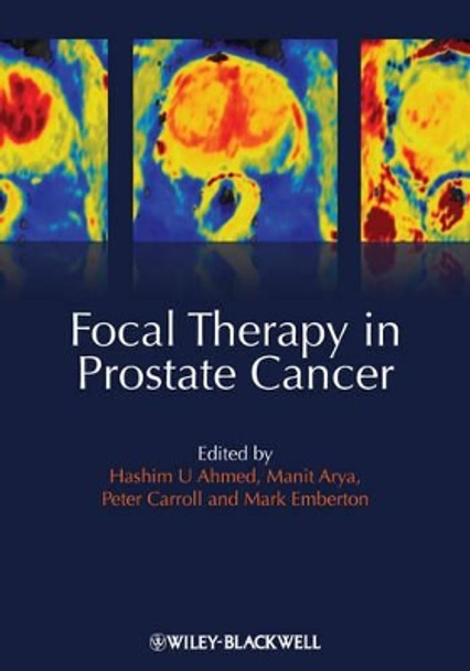 Focal Therapy in Prostate Cancer by Hashim Uddin Ahmed 9781405196499