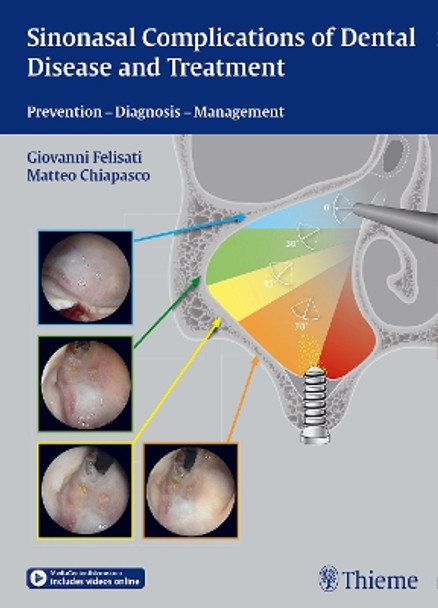 Sinonasal Complications of Dental Disease and Treatment: Prevention - Diagnosis - Management by Giovanni Felisati 9783131997012