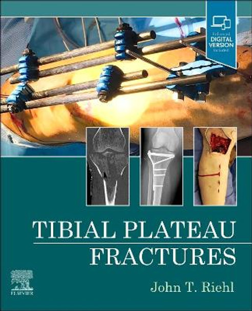 Tibial Plateau Fractures by John Riehl 9780323825689