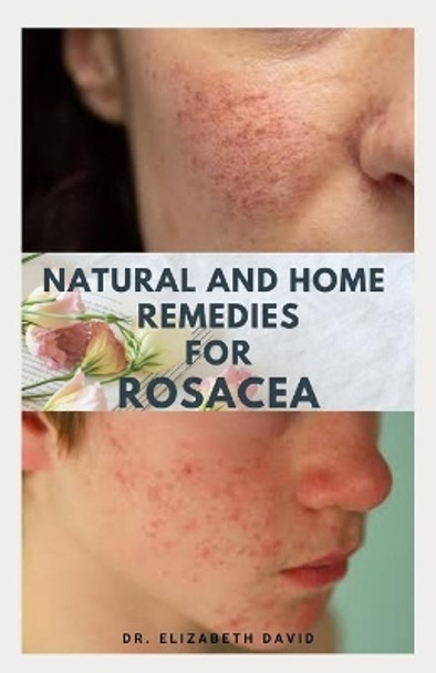 Natural and Home Remedies for Rosacea: A Self Help Guide To Completely Prevent and Treat Rosacea by Dr Elizabeth David 9798645829179
