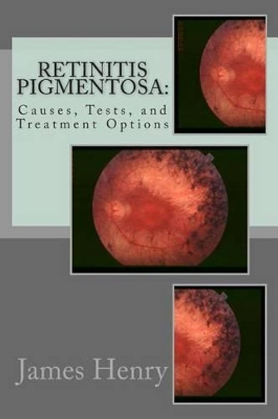 Retinitis Pigmentosa: Causes, Tests, and Treatment Options by Jeremy Norville MD 9781475103878