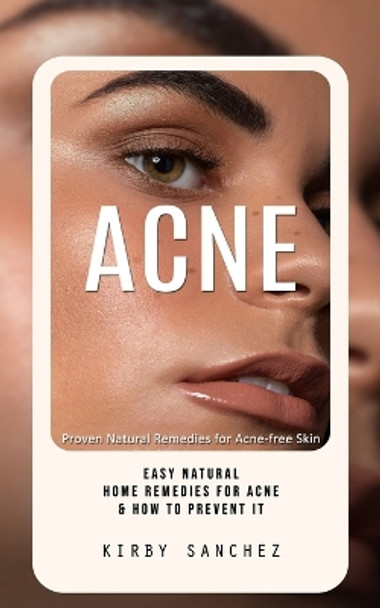 Acne: Proven Natural Remedies for Acne-free Skin (Easy Natural Home Remedies for Acne & How to Prevent It) by Kirby Sanchez 9781777255015