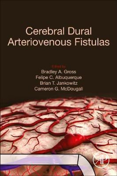 Cerebral Dural Arteriovenous Fistulas by Bradley A. Gross