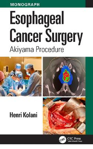 Esophageal Cancer Surgery: Akiyama Procedure Henri Kolani 9781032805825