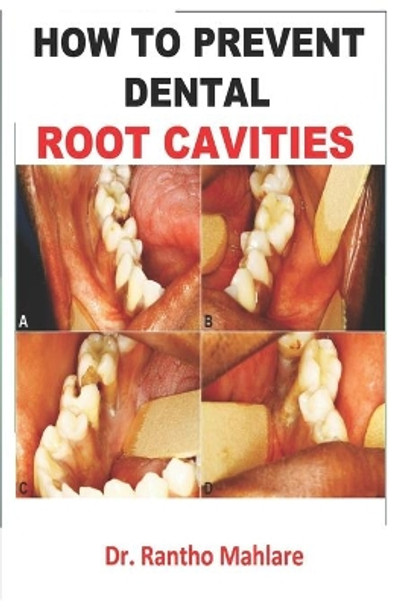 How to Prevent Dental Root Cavities by Rantho Mahlare 9798695406962