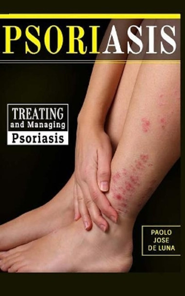 Psoriasis: Treating and Managing Psoriasis by Paolo Jose De Luna 9781517308933