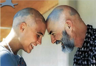 Alopecia Caused by Stress 