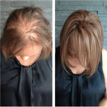 Real Hair Loss Help with Custom Hair Systems for Women
