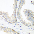 Immunohistochemistry analysis of paraffin-embedded human prostate using NEDD4 antibody (STJ24729) at dilution of 1:200 (40x lens). Perform microwave antigen retrieval with 10 mM PBS buffer pH 7. 2 before commencing with immunohistochemistry staining protocol.