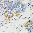 Immunohistochemistry analysis of paraffin-embedded human gastric cancer using SHP2 antibody (STJ25224) at dilution of 1:100 (40x lens). Perform microwave antigen retrieval with 10 mM PBS buffer pH 7. 2 before commencing with immunohistochemistry staining protocol.