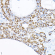 Immunohistochemistry analysis of SAMM50 in paraffin-embedded human liver cancer using SAMM50 Rabbit polyclonal antibody (STJ25440) at dilution of 1:200 (40x lens). Perform high pressure antigen retrieval with 10 mM citrate buffer pH 6. 0 before commencing with immunohistochemistry staining protocol.