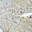 Immunohistochemistry analysis of paraffin-embedded human esophageal cancer using CD138/Syndecan-1 rabbit polyclonal antibody (STJ25457) at dilution of 1:100 (40x lens). Perform high pressure antigen retrieval with 10 mM citrate buffer pH 6. 0 before commencing with immunohistochemistry staining protocol.