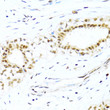 Immunohistochemistry analysis of XRCC4 in paraffin-embedded human breast cancer using XRCC4 Rabbit polyclonal antibody (STJ26132) at dilution of 1:100 (40x lens). Perform microwave antigen retrieval with 10 mM PBS buffer pH 7. 2 before commencing with immunohistochemistry staining protocol.
