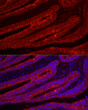 Immunofluorescence analysis of human colon carcinoma using TFF3 Rabbit polyclonal antibody (STJ26190) at dilution of 1:100 (40x lens). Blue: DAPI for nuclear staining.