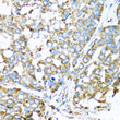 Immunohistochemistry analysis of paraffin-embedded human liver cancer using COX6A1 antibody (STJ26481) at dilution of 1:100 (40x lens). Perform microwave antigen retrieval with 10 mM PBS buffer pH 7. 2 before commencing with immunohistochemistry staining protocol.