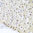 Immunohistochemistry analysis of FUBP1 in paraffin-embedded human liver damage using FUBP1 Rabbit polyclonal antibody (STJ27556) at dilution of 1:100 (40x lens). Perform microwave antigen retrieval with 10 mM PBS buffer pH 7. 2 before commencing with immunohistochemistry staining protocol.