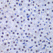 Immunohistochemistry analysis of paraffin-embedded human liver cancer using GST3/GST3/GSTP1 antibody (STJ27658) at dilution of 1:200 (40x lens). Perform microwave antigen retrieval with 10 mM PBS buffer pH 7. 2 before commencing with immunohistochemistry staining protocol.