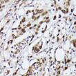 Immunohistochemistry analysis of paraffin-embedded human colon carcinoma using hnRNPM antibody (STJ29017) at dilution of 1:100 (40x lens). Perform microwave antigen retrieval with 10 mM PBS buffer pH 7. 2 before commencing with immunohistochemistry staining protocol.
