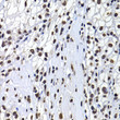 Immunohistochemistry analysis of macroH2A. 1 in paraffin-embedded human kidney cancer using [KO Validated] macroH2A. 1 Rabbit polyclonal antibody (STJ29125) at dilution of 1:100 (40x lens). Perform microwave antigen retrieval with 10 mM PBS buffer pH 7. 2 before commencing with immunohistochemistry staining protocol.