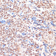 Immunohistochemistry analysis of NAA20 in paraffin-embedded human oophoroma using NAA20 Rabbit polyclonal antibody (STJ29185) at dilution of 1:100 (40x lens). Perform microwave antigen retrieval with 10 mM PBS buffer pH 7. 2 before commencing with immunohistochemistry staining protocol.