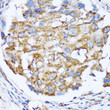 Immunohistochemistry analysis of paraffin-embedded human breast cancer using NDE1 antibody (STJ29192) at dilution of 1:100 (40x lens). Perform microwave antigen retrieval with 10 mM PBS buffer pH 7. 2 before commencing with immunohistochemistry staining protocol.