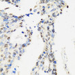 Immunohistochemistry analysis of paraffin-embedded human rectal cancer using CCAR2 antibody (STJ29206) at dilution of 1:100 (40x lens). Perform microwave antigen retrieval with 10 mM PBS buffer pH 7. 2 before commencing with immunohistochemistry staining protocol.