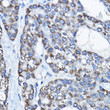 Immunohistochemistry analysis of paraffin-embedded human liver cancer using UBE3A rabbit polyclonal antibody (STJ29866) at dilution of 1:100 (40x lens). Perform high pressure antigen retrieval with 10 mM citrate buffer pH 6. 0 before commencing with immunohistochemistry staining protocol.