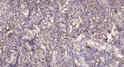 Immunohistochemical analysis of paraffin-embedded human lung cancer. 1, Antibody was diluted at 1:200 (4°C overnight). STJ194715