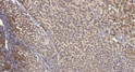 Immunohistochemical analysis of paraffin-embedded human liver cancer. 1, Antibody was diluted at 1:200 (4°C overnight). STJ194716
