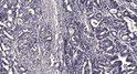 Immunohistochemical analysis of paraffin-embedded human gastric adenocarcinoma. 1, Antibody was diluted at 1:200 (4° STJ194721