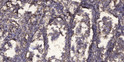 Immunohistochemical analysis of paraffin-embedded human squamous cell carcinoma of lung. 1, Antibody was diluted at STJ194735