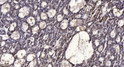 Immunohistochemical analysis of paraffin-embedded human liver cancer. 1, Antibody was diluted at 1:200 (4°C overnight). STJ194736