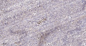 Immunohistochemical analysis of paraffin-embedded human colon cancer. 1, Antibody was diluted at 1:200 (4° overnight). STJ194737