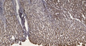 Immunohistochemical analysis of paraffin-embedded human liver cancer. 1, Antibody was diluted at 1:200 (4°C overnight). STJ194744